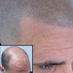 Närbild på en rakad skalle med en insatt bild som visar markerade punkter för hårtransplantation. Frågan om hårtransplantation är haram är relevant för många.