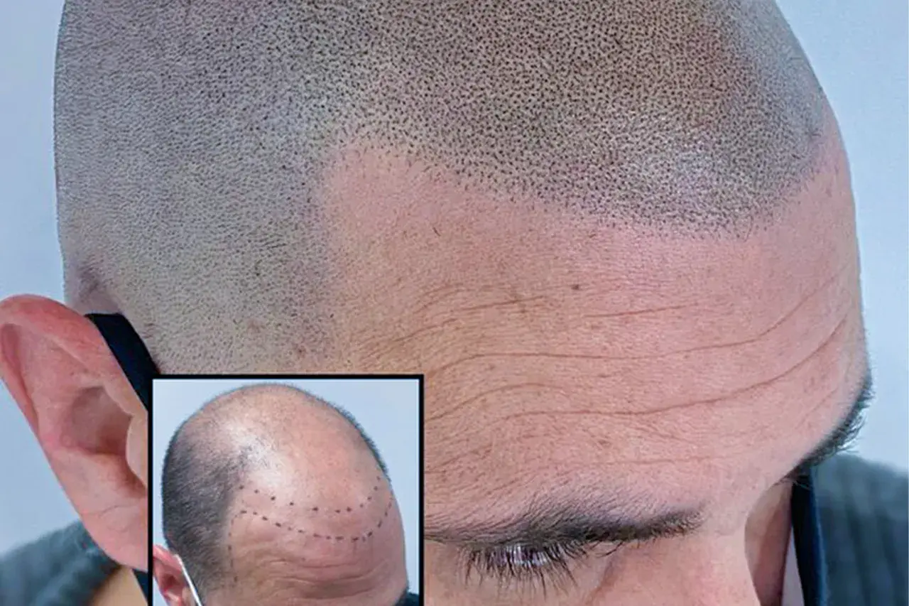 Närbild på en rakad skalle med en insatt bild som visar markerade punkter för hårtransplantation. Frågan om hårtransplantation är haram är relevant för många.
